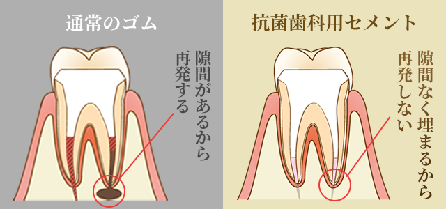 歯科用抗菌セメント