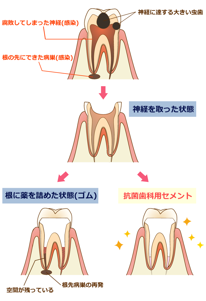 抗菌性歯内療法